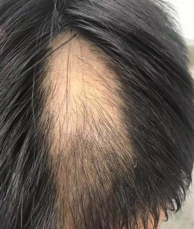 拔毛癖怎么治療?