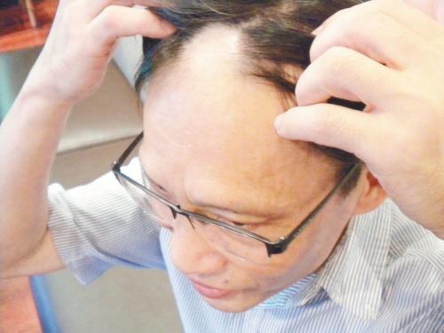 什么是拔毛癖？為什么一焦慮就拔頭發(fā)？
