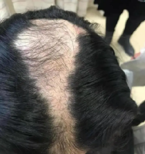 孩子咬手指至變形是什么心理？